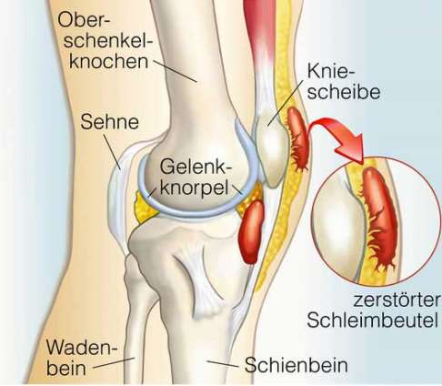 Infolge der Entzündung können Schleimbeutel vernarben und ihre Elastizität verlieren. Wiederkehrende Entzündungen werden immer wahrscheinlicher. Häufig ist dann die operative Entfernung des Schleimbeutels (Bursektomie) eine effektive Therapie der Bursitis am Knie. © Henrie @ fotolia zerstörter Schleimbeutel