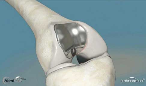 Patellofemorale Knieteilprothese: Ein Metallimplantat am Oberschenkel zwischen den beiden Oberschenkelrollen kleidet die Patellagleitrinne (Trochlea) aus. Ein gleitfähiges Polyethylen-Implantat auf der Rückseite der Kniescheibe bildet die Gleitpaarung mit dem Titanimplantat. Wir ziehen die einwachsenden, knochensparenden HemiCAP-Implantate den zementierten Implantaten vor. © 2med Patellofemorale Knieteilprothese