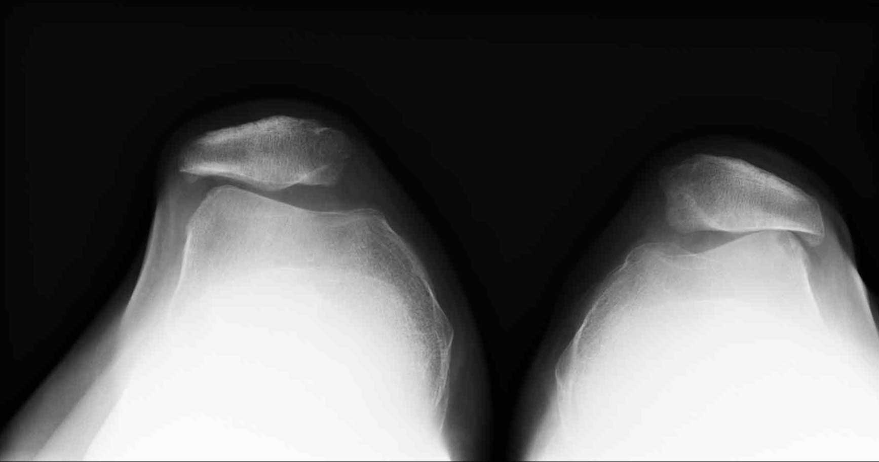 Röntgenbild einer Retropatellararthrose: Bei dieser sog. Defilee-Aufnahme liegt der Patient mit angezogenen Beinen auf dem Rücken. Das Röntgenbild zeigt bei beiden femoropatellaren Gelenken des Patienten den Zustand des Gelenkspaltes. Links ist ein Gelenkspalt mit leichter Arthrose. Patella und Trochlea (Gleitlager der Kniescheibe) haben durchweg einen Abstand von mehr als 3 mm. Rechts ist ein patellofemorales Gelenk mit fortgeschrittener Arthrose. Patella und Femur berühren sich. Die Knorpelschicht zwischen den beiden Gelenkpartnern ist komplett abgetragen. © Gelenk-Klinik Röntgenbild einer Retropatellararthrose