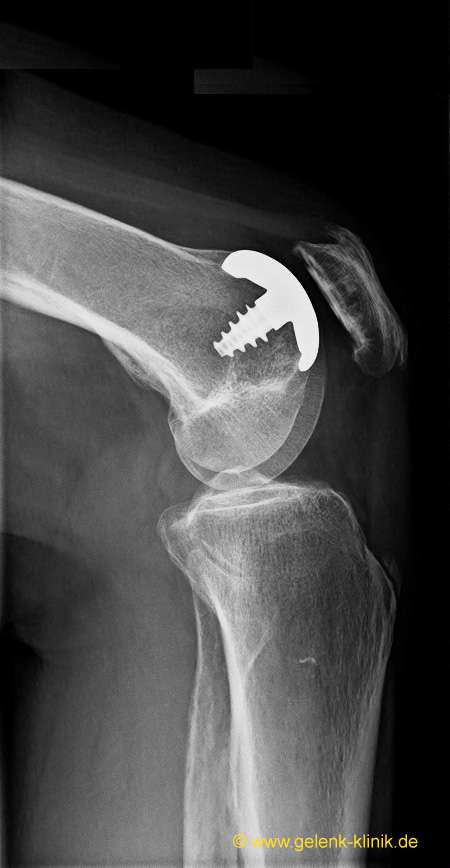Wenn die retropatellare Arthrose beide Gelenkflächen – Patella und Oberschenkel – betrifft, kommt eine retropatellare Prothese mit patellaseitiger PET-Gleitschicht zum Einsatz. Dieses Röntgenbild zeigt nur die Metallkomponente. Der Kunststoff wird im Röntgen nicht dargestellt. © Prof. Dr. med. Ostermeier retropatellare Prothese im Röntgen