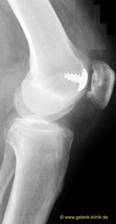 Seitliches Röntgenbild dach der Implantation einer patellofemoralen Prothese. © Gelenk-Klinik Seitliches Röntgenbild dach der Implantation einer patellofemoralen Prothese