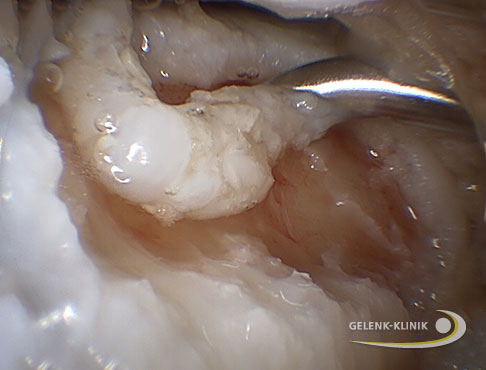 Kniearthroskopie: Mit einem feinen Instrument werden 0,3-0,4 mm kleine Knorpelchips aus dem Knie entnommen, gesammelt und mit körpereigenem thrombinhaltigen Plasma vermischt. © Gelenk-Klinik Entnahme von Knorpelchips aus dem Knie