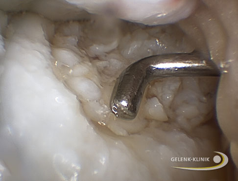 Die Aufnahme zeigt einen Knorpeldefekt im Kniegelenk. Der Defekt wurde mit körpereigenen Knorpelchips und Blutplasma des Patienten aufgefüllt. Beides befindet sich unterhalb des Instruments. © Gelenk-Klinik Knorpeldefekt im Kniegelenk mit Knorpelchips