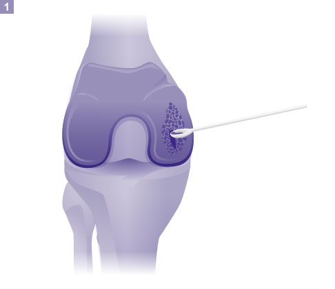 1. Schritt: Entnahme von Knorpelgewebe, Zerkleinern zu Knorpelchips. © Gelenk-Klinik Entnahme von Knorpelgewebe, Zerkleinern zu Knorpelchips