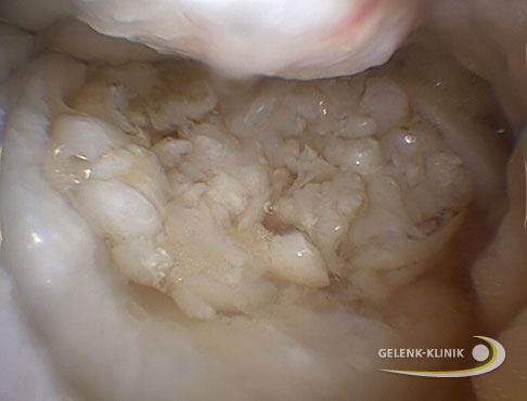 Kniearthroskopie: Das fertige Knorpeltransplantat ist nun stabil und füllt den ehemaligen Defekt aus. © Gelenk-Klinik fertige Knorpeltransplantat ist nun stabil