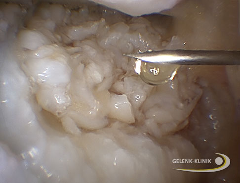 Kniearthroskopie: Versiegelung der Knorpelchips-Paste durch körpereigenes Thrombin und Plasma. © Gelenk-Klinik Versiegelung der Knorpelchips-Paste