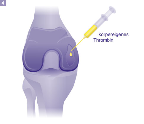 4. Schritt: Fixieren des Knorpelimplantats mit Thrombin aus dem Patientenblut. © Gelenk-Klinik Fixieren des Knorpelimplantats mit Thrombin