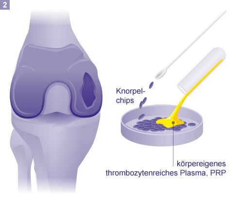 2. Schritt: Vermischen der Knorpelchips mit körpereigenem thrombozytenreichem Plasma (PRP). © Gelenk-Klinik Vermischen der Knorpelchips mit körpereigenem PRP