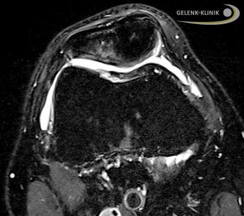 Der Gelenkknorpel ist sehr gut wiederhergestellt und das Transplantat hat sich in die Umgebung integriert. Während des Regenerationsprozesses hat sich auch das Knochenmarködem der Kniescheibe zurückgebildet. © Gelenk-Klinik Nach 9 Monaten, quer