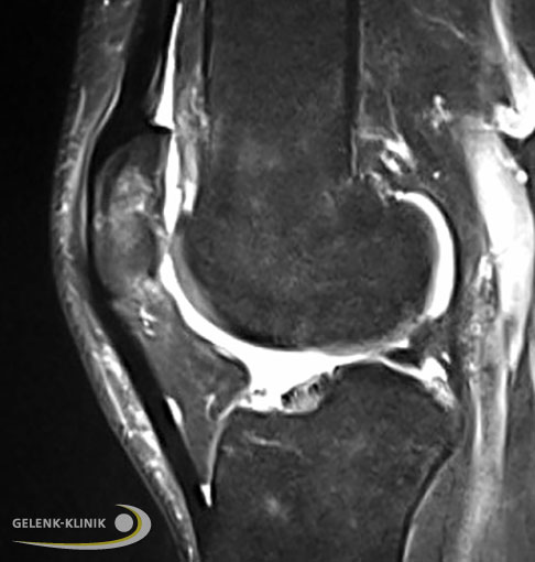 MRT-Aufnahmen des gleichen Knorpelschadens 9 Monate nach operativer Knorpelchips-Transplantation (links seitlich, rechts Querschnitt). © Gelenk-Klinik Nach 9 Monaten, seitlich