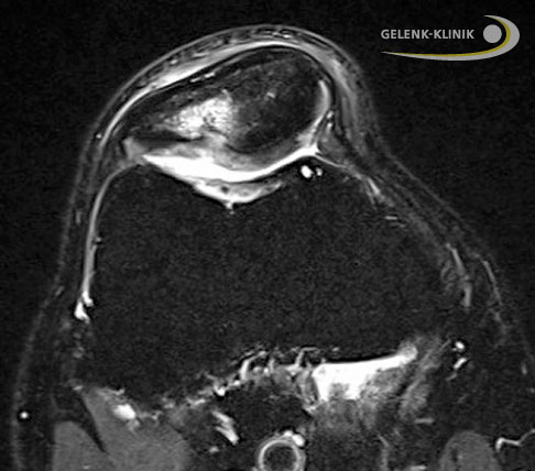 Als Folge des Knorpelschadens hat sich zusätzlich eine Flüssigkeitsansammlung im Knochen der Kniescheibe (Patella) gebildet. Das Knochenödem stellt sich als aufgehellter Bereich oben im MRT-Bild dar. © Gelenk-Klinik Knorpelschaden im Kniegelenk, quer