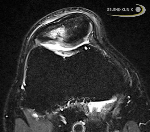 Knorpelschaden im Kniegelenk, quer