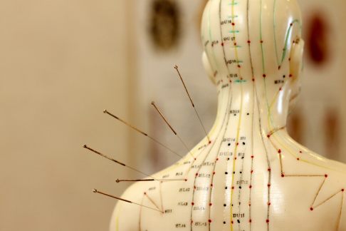 Bei der Akupunktur werden entlang von Meridianen spezielle Nadeln in die Haut gestochen. © stock.adobe.com, bcorn