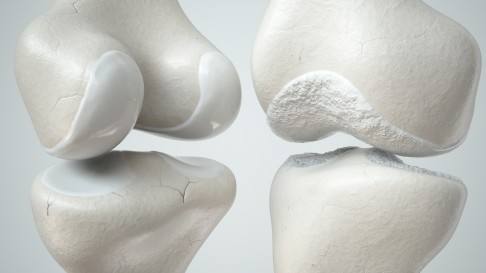 Darstellung des Kniegelenks mit Knorpel. Links gesunder, glatter Knorpel; rechts ist der Knorpel beschädigt, rauh und ausgedünnt. Eine Ursache für krankhaften Knorpelabbau sind wiederholte Kortisoninjektionen in das Gelenk. © crevis, Adobe Kortison Nebenwirkung auf das Kniegelenk
