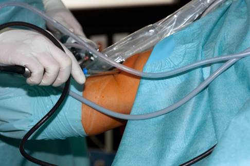 Der Meniskus kann arthroskopisch im Rahmen einer minimalinvasiven Operation behandelt werden. Dabei ist die Teilentfernung des Meniskus (Glättung) der am häufigsten durchgeführte Eingriff. © smartmediadesign, Fotolia Kniearthroskopie