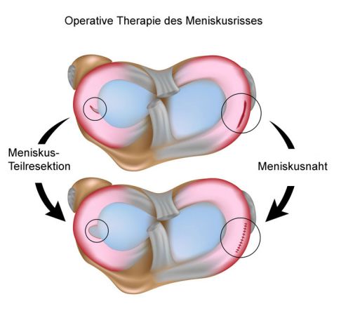 Die Naht des Meniskus ist nur dann möglich, wenn der Meniskusriss in der Nähe der gut durchbluteten Basis des Meniskus liegt. Bei der Meniskusresektion entfernt der Operateur einen Teil des beschädigten Meniskus, um die Oberfläche zu glätten. © Alila Medical Media @ Fotolia Operation bei Meniskusriss