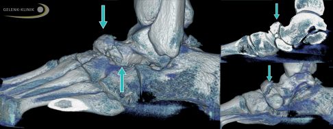 Die Digitale Volumentomographie (DVT) zeigt den Defekt und die Fehlstellung des Kahnbeins bei Müller-Weiss-Syndrom im Stehen (Pfeile). Diese Aufnahmen unter Belastung nutzt der Spezialist für die Therapieplanung, die er an die Situation des Patienten anpasst. © Gelenk-Klinik DVT bei Müller-Weiss-Syndrom im Stehen