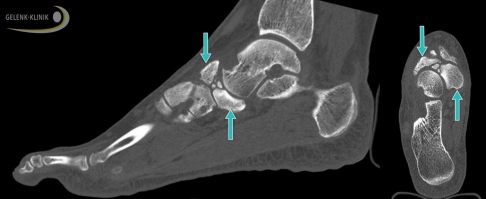 Die Schnittbilder der digitalen Volumentomografie (DVT) zeigen ein gebrochenes Kahnbein bei Müller-Weiss-Syndrom. Die Fraktur des Kahnbeins ist in der Seitenansicht des Fußes (links) und der Ansicht von oben (rechts) durch Pfeile gekennzeichnet. © Gelenk-Klinik Gebrochenes Kahnbein