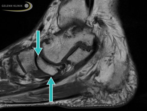 Magnetresonanztomographie (MRT) bei Müller-Weiss-Syndrom: Das defekte Kahnbeinfragment sinkt im Fuß nach unten ab (Pfeile). Es verdrängt und komprimiert die darunter liegenden Weichteile. © Gelenk-Klinik MRT bei Müller-Weiss-Syndrom