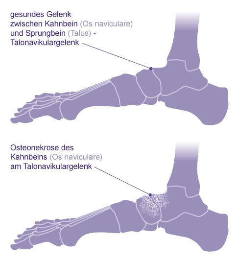 Vergleich eines gesunden Talonavikulargelenks mit einer Osteonekrose des Kahnbeins bei Müller-Weiss-Syndrom. Das vordere untere Sprunggelenk zwischen Kahnbein (Os naviculare) und Sprungbein (Talus) ist unmittelbar mitbetroffen. © Gelenk-Klinik Osteonekrose am Kahnbein