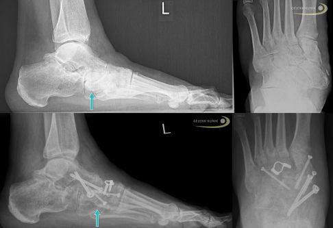 Röntgenbilder eines fortgeschrittenen Müller-Weiss-Syndroms vor OP (oben) und nach Versteifungsoperation (Arthrodese, unten). Der Kahnbeinknochen ist stark geschädigt und hat eine ausgeprägte Fehlstellung des Fußes verursacht. Der Operateur hat die Stellung des Fußes durch die Versteifung der Gelenke zwischen Sprungbein und Kahnbein (Talonavikulargelenk) sowie der Gelenke zwischen Kahnbein und Keilbeinen mittels Schrauben und Spangen korrigiert. Der Knochendefekt wurde mit Knochenspänen aus dem Beckenkamm des Patienten ausgeglichen (autologer Knochentransfer). © Gelenk-Klinik Arthrodese bei fortgeschrittenem Müller-Weiss-Syndrom