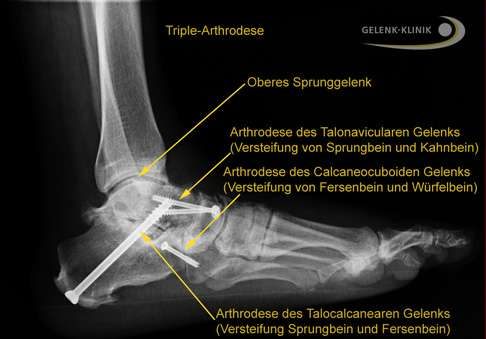 Röntgenbild der Triple-Arthrodese aller drei Abschnitte des unteren Sprunggelenks (USG). © Gelenk-Klinik.de Triple-Arthrodese bei Müller-Weiss-Syndrom