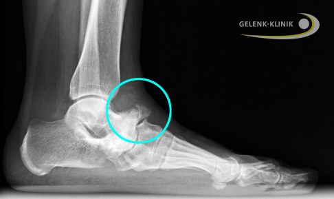 Röntgenbild seitlich: Im späten Stadium des Müller-Weiss-Syndroms sind das Fersenbein (Calcaneus) und das Fußlängsgewölbe abgesunken. Im Kreis ist das nach oben heraustretende Knochenstück des Kahnbeins sichtbar. Die Schädigung betrifft bereits das nachfolgende Gelenk zwischen Kahnbein und Keilbein. © Gelenk-Klinik Röntgenbild Müller-Weiss-Syndrom