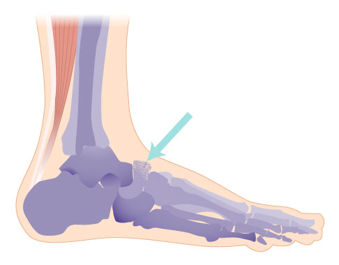 Erscheinungsform des Müller-Weiss-Syndroms: Sklerosierung des Kahnbeins und Ausbildung einer Komma-Form und Verlagerung des Kahnbeins zum Fußrücken aus seiner normalen Position (dorsalseitige Subluxation). © Gelenk-Klinik Schematische darstellung des Müller-Weiß-Syndrom