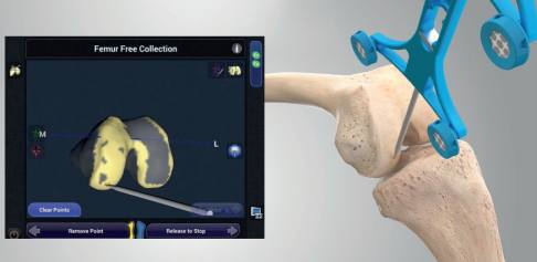 Der Operateur fährt vor der Operation mit einem Handstück die anatomischen Kniestrukturen des Patienten ab. Die Daten werden auf einen Computer übertragen und ersetzen die präoperative Computertomographie. Das NAVIO-System erstellt ein dreidimensionales Kniemodell, das dem Arzt für die gesamte Dauer der Operation zur Verfügung steht. Mit freundlicher Genehmigung von Smith&Nephew Kniemodell im Computer dargestellt
