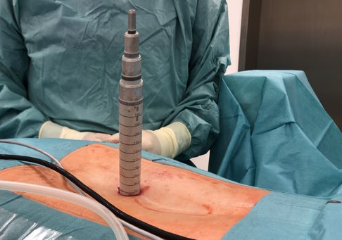 Der Patient liegt bei der mikrochirurgischen Dekompression auf dem Bauch. Hier wurde das minimalinvasive Zugangssystem direkt über einem Bandscheibenvorfall platziert, um den Vorfall mithilfe des Mikroskops zu identifizieren und zu entfernen. © Gelenk-Klinik Minimalinvasiver Zugang bei mikrochirurgischer Dekompression.