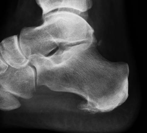 Im Röntgenbild ist ein Kalksporn unten am Fersenbein sichtbar. Der untere Fersensporn entsteht durch Kalkeinlagerungen infolge langwieriger Entzündungen am Ansatz der Plantarsehne. © Gelenk-Klinik unterer Fersensporn im Röntgenbild