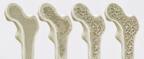 Osteoporose verläuft in vier Stadien: Der Kalziumgehalt im Knochen verringert sich, die Knochendichte nimmt ab und der Knochen wird spröde. Im Endstadium bricht der Knochen sehr leicht. © crevis, Fotolia Vier Stadien der Osteoporose