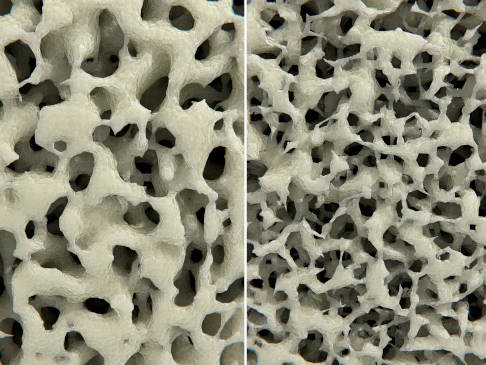 Knochenstruktur bei Osteoporose. Links gesundes Knochengewebe. Rechts erkennt man den porös gewordenen Knochen mit deutlich größeren Zwischenräumen als Zeichen von verminderter Knochenmasse und -dichte. © Juan Gärtner, Adobe Knochenstruktur bei Osteoporose