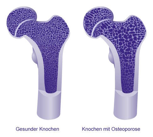 Bei einem gesunden Knochen ist die Knochenstruktur wesentlich dichter und stabiler als bei einem Knochen mit Osteoporose. © Gelenk-Klinik Vergleich gesunder Knochen und Knochen mit Osteoporose