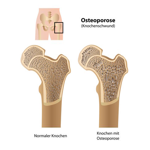 Osteoporose tritt besonders häufig am Oberschenkelhals auf. Sie stellt den Orthopäden beim Einsatz einer Prothese vor eine besondere Herausforderung. © bilderzwerg, Adobe Osteoporose am Oberschenkelhals