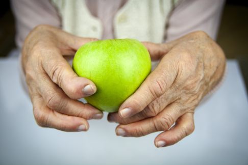 Bei ausgeprägter rheumatoider Arthritis fällt es den Betroffenen schon schwer, einen Apfel zu greifen - geschweige denn, ihn zu schälen oder zu zerteilen. © hriana, stock.adobe.com An Rheuma erkrankte Hand hält Apfel