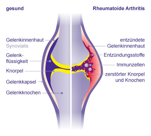 Bei einer rheumatoiden Arthritis entzündet sich die Gelenkinnenhaut. Um das Gelenk zu sanieren, führt der Arzt eine Synovektomie durch. © Gelenk-Klinik Vergleich gesundes Gelenk und Gelenk mit rheumatoider Arthritis