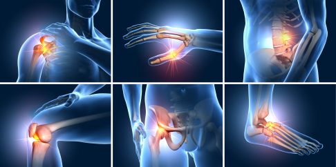 Arthritis kann in jedem Gelenk vorkommen. Bei manchen Betroffenen sind eher die Hände, bei anderen die Knie, die Schultern, der Rücken, die Hüfte oder die Füße betroffen. © Axel Kock, stock.adobe.com Gezeichnete Darstellung von sechs entzündeten Körpergelenken