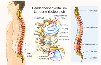 Je nach Höhe des Bandscheibenvorfalls in der Wirbelsäule können unterschiedliche Symptome auftreten. Die aus der Lendenwirbelsäule austretenden Nervenwurzeln versorgen die unteren Extremitäten. Werden sie komprimiert, kommt es zu Schmerzen und Gefühlsstörungen in den Beinen. © Henrie, Fotolia Bandscheibenvorfall im Ledenwirbelbereich