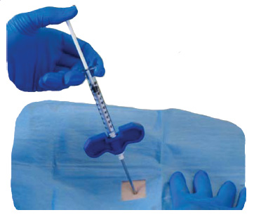 Die Kyphoplastie ist die Wiederaufrichtung und Stabilisierung des Wirbelbruchs mit Knochenzement. Die Operation erfolgt transkutan (durch die Haut) mit einer Hohlnadel. © Via4spine Operation einer Kyphoplastie