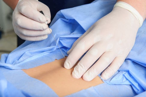 Die interventionelle Schmerztherapie vereint mehrere Verfahren zur Behandlung von Rückenschmerzen. © manovar1973, Adobe Interventionelle Schmerztherapie