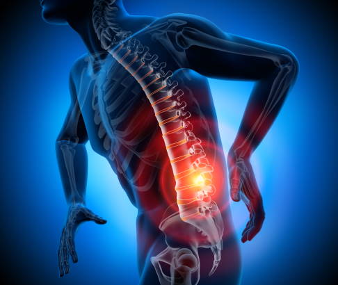 Eine Spinalkanalstenose kann zu fast unerträglichen Schmerzen im unteren Rücken führen. Oft strahlen diese auch aus und es entwickeln sich starke Beinschmerzen, die das Gehen erschweren. © peterschreiber.media, Adobe Stock Grafik: Mann mit Schmerzen im unteren Rücken bei Morbus Bechterew