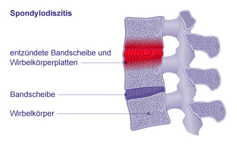 Die Entzündung bei einer Spondylodiszitis geht häufig von der Bandscheibe aus, um dann auf die benachbarten Wirbelkörperplatten überzugreifen. © Gelenk-Klinik Darstellung einer Spondylodiszitis mit entzündeter Bandscheibe und Wirbelkörperplatten