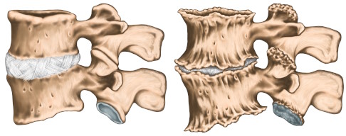 Gesunde Wirbelkörper (links) und Wirbelkörper mit Spondylophyten (rechts). Die Knochenanbauten lassen sich an den Rändern der Wirbelkörper und im Bereich der Zwischenwirbelgelenke gut erkennen. © stihii, shutterstock.com Abbildungen von Spondylophyten aus verschiedenen Perspektiven