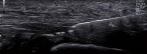 Perkutane Gewebeablation bei Morbus Ledderhose: Die Sonde kommt auf dieser Abbildung von rechts. Die Kontrolle unter Ultraschall ergibt eine gute Übersicht und damit gezielte Behandlung der erkrankten Strukturen. Eine Eröffnung ist daher nur ergänzend sinnvoll. © Gelenk-Klinik TX-Sonde im Ultraschallbild