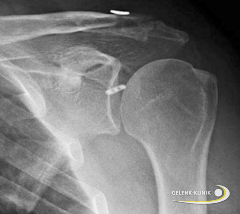 Arthroskopisch durchgeführte Stabilisierung des Schultereckgelenks bei einem Patienten mit akuter AC-Gelenksprengung. © Gelenk-Klinik Arthroskopisch durchgeführte Stabilisierung des Schultereckgelenks