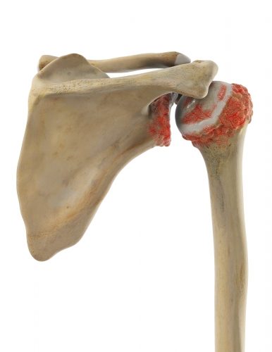 Verschleiß, Unfall und Krankheit können zum Verlust der Knorpelfläche im Schultergelenk führen. Als Folge bilden sich knöcherne Anbauten (Osteophyten), die den Abrieb des noch vorhandenen Knorpels stark beschleunigen. © Viewmedica Symptome der Schulterarthrose