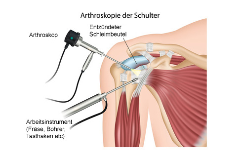 Während einer Schulterarthroskopie entfernt der Orthopäde den entzündeten Schleimbeutel. © bilderzwerg / fotolia Bursektomie im Rahmen einer Schulterarthroskopie