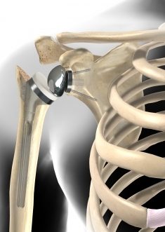 Eine Schulterprothese stellt die schmerzfreie Beweglichkeit des Gelenks wieder her. © Viewmedica Schulterprothese