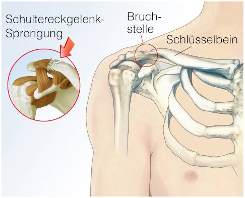 Schultereckgelenksprengung